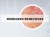 银屑病能吃面条吗 银屑病能不能吃面包