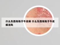 什么东西有助于牛皮癣 什么东西有助于牛皮癣消失