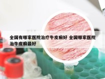 全国有哪家医院治疗牛皮癣好 全国哪家医院治牛皮癣最好