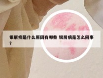 银屑病是什么原因有哪些 银屑病是怎么回事?