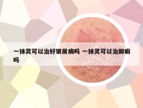 一抹灵可以治好银屑病吗 一抹灵可以治脚癣吗