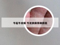 牛起牛皮癣 牛皮肤癣得病原因