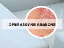 关于银屑病常见的问题 银屑病相关问题
