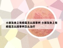 小朋友身上有癣是怎么回事啊 小朋友身上有癣是怎么回事啊怎么治疗
