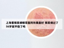 上海看银屑病哪家医院效果最好 银屑病过了50岁就平稳了吗