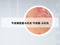 牛皮癣患者小红点 牛皮癣 小红点