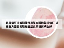 银屑病可以长期使用用复方醋酸氟轻松酊 涂抹复方醋酸氟轻松酊后几天银屑病会好