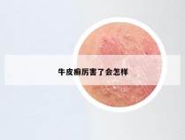 牛皮癣厉害了会怎样