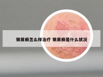 银屑癣怎么样治疗 银屑癣是什么状况