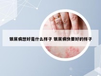 银屑病想好是什么样子 银屑病快要好的样子