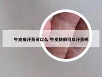 牛皮癣汗蒸可以么 牛皮肤癣可以汗蒸吗