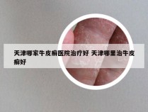 天津哪家牛皮癣医院治疗好 天津哪里治牛皮癣好
