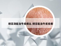 绿豆汤能治牛皮癣么 绿豆能治牛皮皮癣