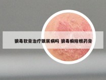 狼毒软膏治疗银屑病吗 狼毒癣除根药膏