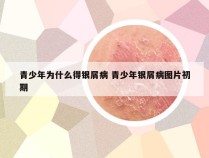 青少年为什么得银屑病 青少年银屑病图片初期