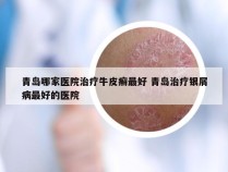 青岛哪家医院治疗牛皮癣最好 青岛治疗银屑病最好的医院