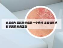 银屑病与掌跖脓疱病是一个病吗 掌跖银屑病和掌跖脓疱病区别