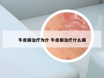 牛皮癣治疗为什 牛皮癣治疗什么病