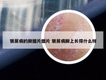 银屑病的脚图片图片 银屑病脚上长得什么样