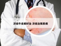 济南牛皮癣好治 济南治银屑病
