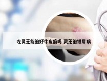 吃灵芝能治好牛皮癣吗 灵芝治银屑病