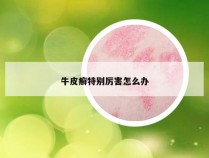 牛皮癣特别厉害怎么办