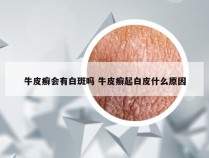 牛皮癣会有白斑吗 牛皮癣起白皮什么原因