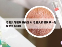 毛囊炎与银屑病的区分 毛囊炎和银屑病一起发生怎么回事