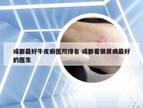 成都最好牛皮癣医院排名 成都看银屑病最好的医生