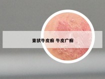 束状牛皮癣 牛皮广癣
