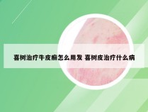 喜树治疗牛皮癣怎么用发 喜树皮治疗什么病