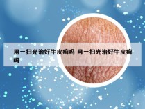 用一扫光治好牛皮癣吗 用一扫光治好牛皮癣吗