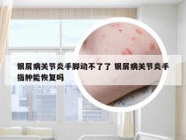 银屑病关节炎手脚动不了了 银屑病关节炎手指肿能恢复吗