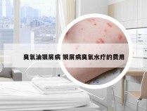 臭氧油银屑病 银屑病臭氧水疗的费用