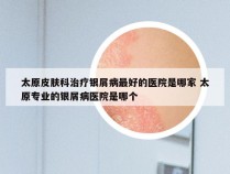 太原皮肤科治疗银屑病最好的医院是哪家 太原专业的银屑病医院是哪个