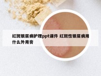 红斑银屑病护理ppt课件 红斑性银屑病用什么外用膏