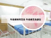 牛皮癣如何艾灸 牛皮癣艾灸部位