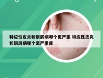 特应性皮炎和银屑病哪个更严重 特应性皮炎和银屑病哪个更严重些