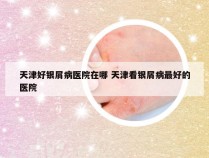 天津好银屑病医院在哪 天津看银屑病最好的医院