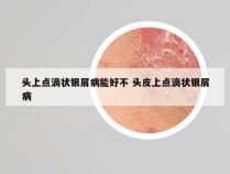 头上点滴状银屑病能好不 头皮上点滴状银屑病