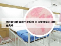 马应龙痔疮膏治牛皮癣吗 马应龙痔疮可以擦皮炎吗