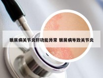 银屑病关节炎肝功能异常 银屑病导致关节炎