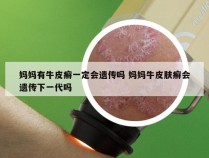 妈妈有牛皮癣一定会遗传吗 妈妈牛皮肤癣会遗传下一代吗