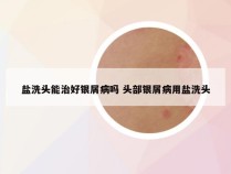 盐洗头能治好银屑病吗 头部银屑病用盐洗头