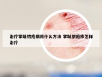 治疗掌趾脓疱病用什么方法 掌趾脓疱疹怎样治疗