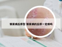 银屑病丘疹型 银屑病的丘疹一定痒吗