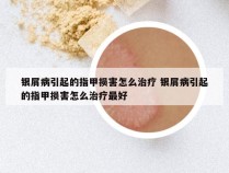 银屑病引起的指甲损害怎么治疗 银屑病引起的指甲损害怎么治疗最好