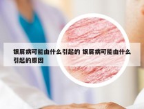 银屑病可能由什么引起的 银屑病可能由什么引起的原因