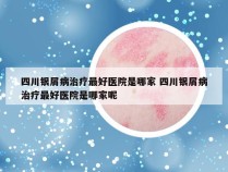 四川银屑病治疗最好医院是哪家 四川银屑病治疗最好医院是哪家呢