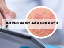 止痛膏能治银屑病吗 止痛膏能治银屑病吗图片